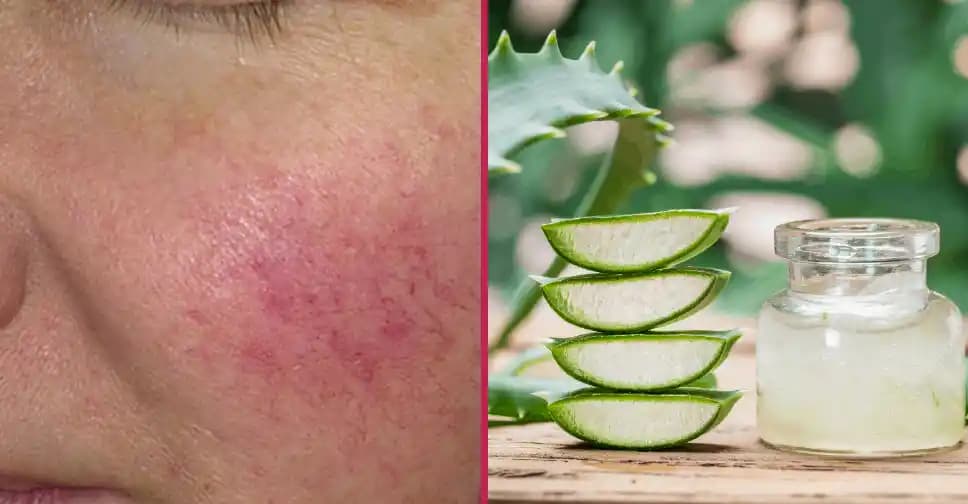 Gül Hastalığına Karşı Doğal Yağlar ve Cilt Bakım Rehberi