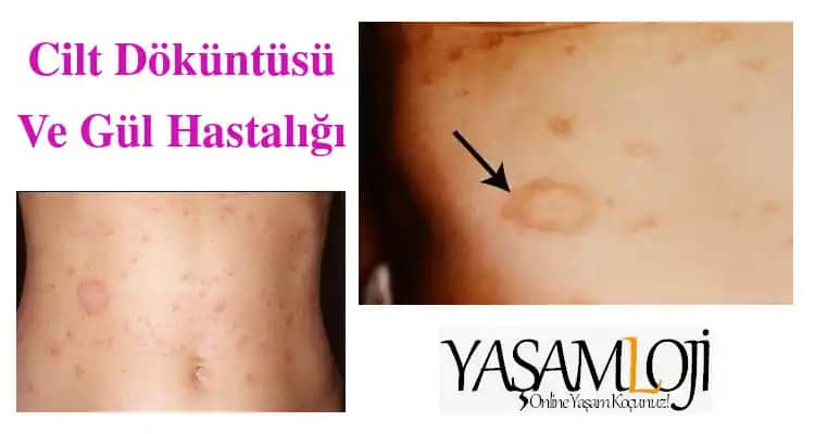 Gül Hastalığına Karşı Kozmetik ve Doğal Çözümlerle Cilt Bakımı Rehberi