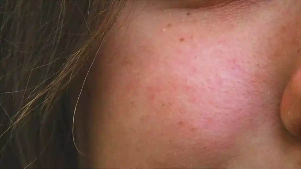 Gül Hastalığında Doğru Beslenme ve Cilt Sağlığı İçin Önemli İpuçları