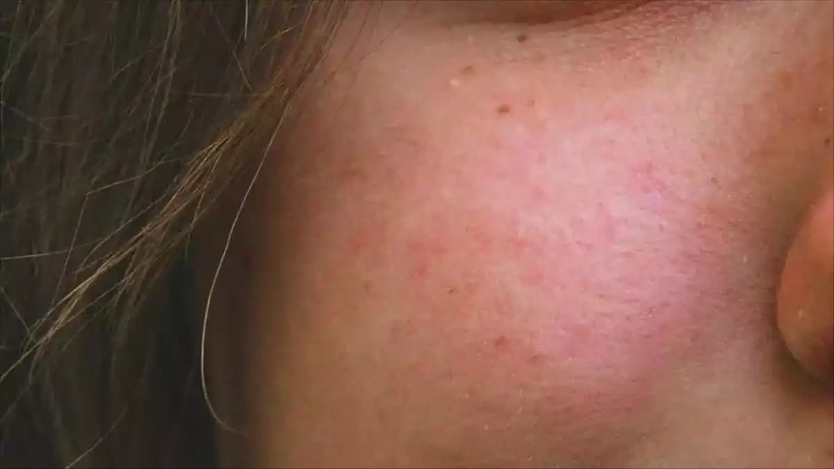 Gül Hastalığında Doğru Beslenme ve Cilt Sağlığı İçin Önemli İpuçları