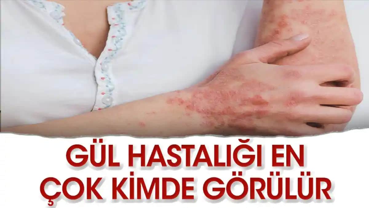 Gül Hastalığının Belirtileri, Kozmetik Çözümleri ve Tedavi Yöntemleri