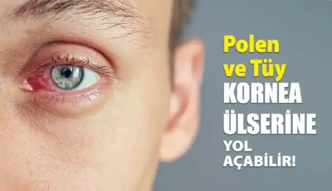 Güneş Alerjisi ve Göz Sağlığı: Korunma Yöntemleri ve Bakım İpuçları