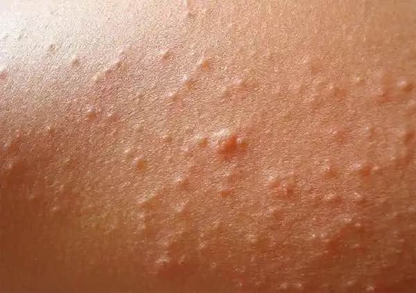 Güneş Alerjisi ve Sivilce İlişkisi: Cilt Sağlığını Korumanın Yolları