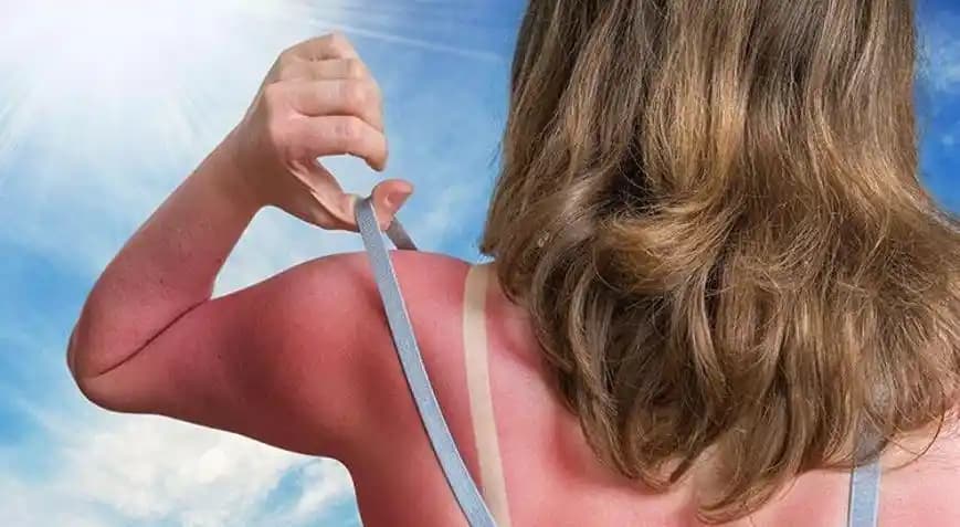 Güneş Kaşıntısına Karşı Etkili Yatıştırıcı ve Koruyucu Cilt Bakım Yöntemleri