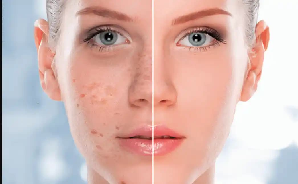 Güneş Lekeleri Nedenleri, Önlemleri ve Etkili Tedavi Yöntemleri Hakkında Bilgi