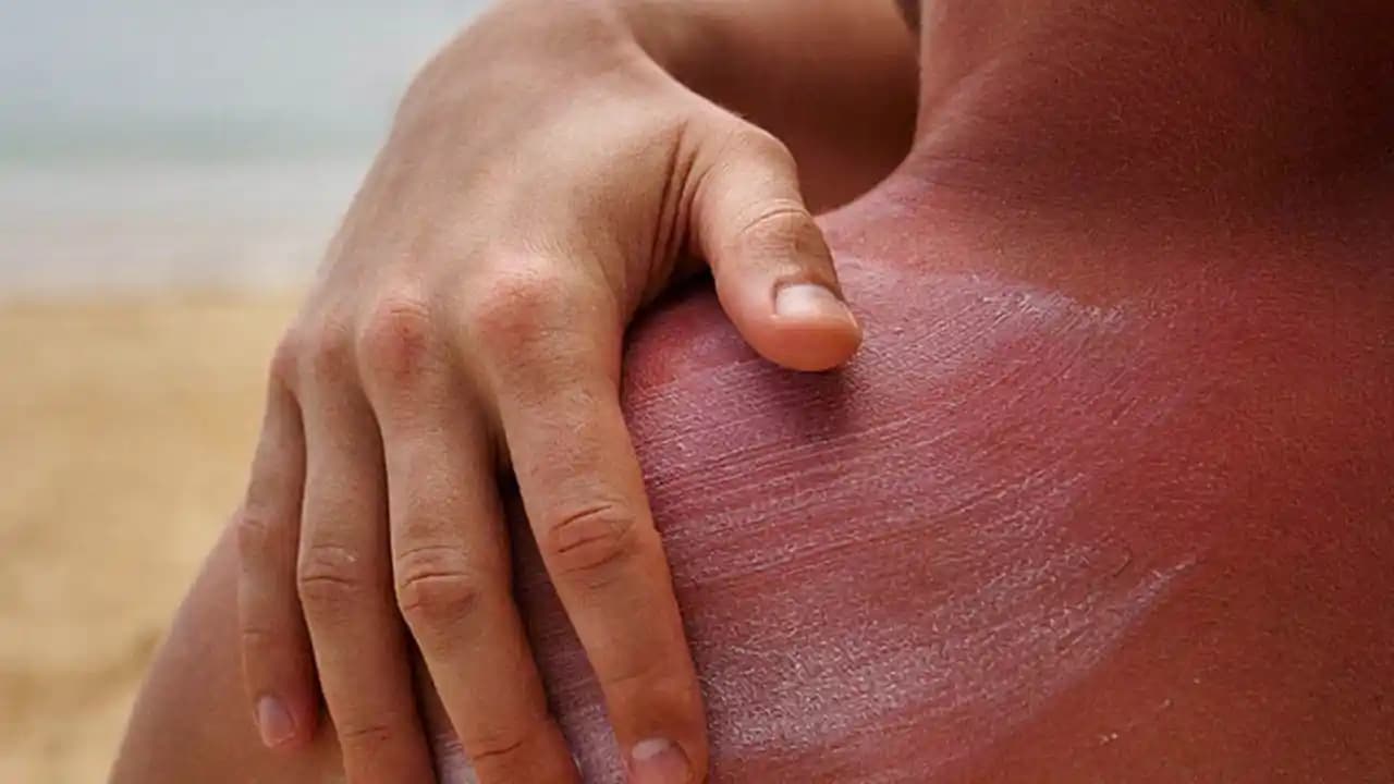 Güneş Siyahlığı Nasıl Geçer Güneş Lekelerine Karşı Etkili Yöntemler ve Koruma İpuçları