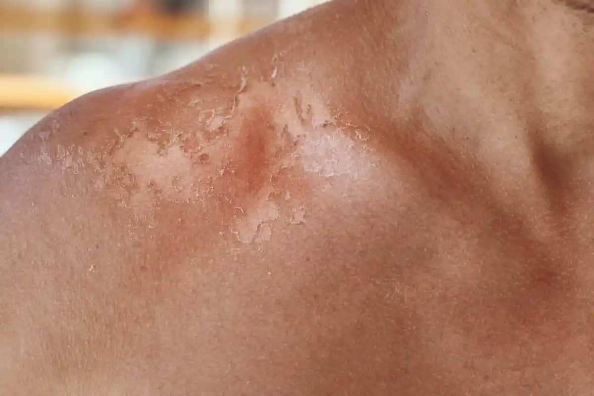 Güneş Yanığına İyi Gelen Doğru Cilt Bakım Yöntemleri ve Önlemler