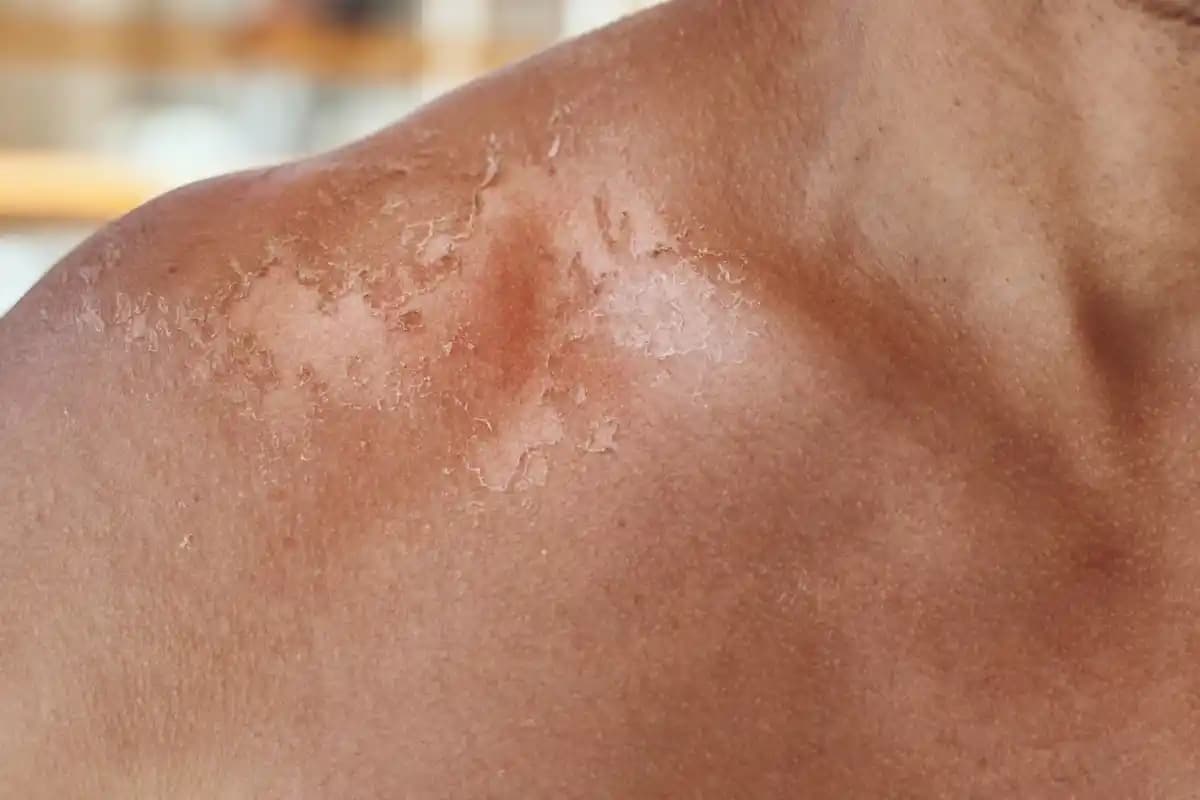 Güneş Yanığına İyi Gelen Doğru Cilt Bakım Yöntemleri ve Önlemler