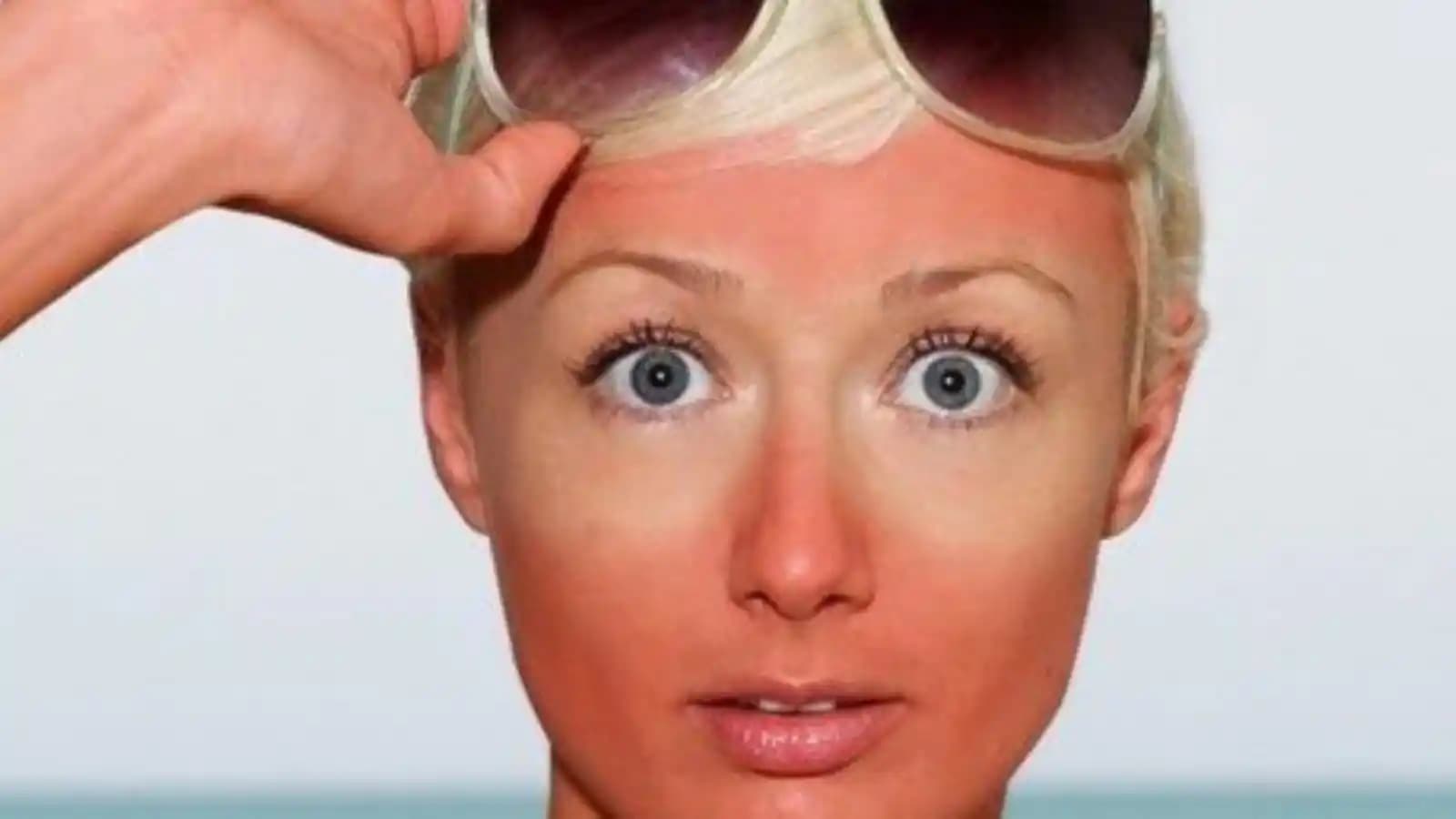 Güneşte Kızaran Yüze Doğru Bakım ve Rahatlatıcı Yöntemler