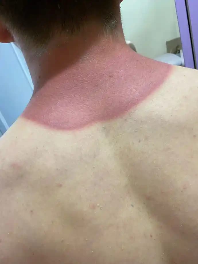 Güneşte Yanma ve Cilt Sağlığı Üzerindeki Etkileri ile Korunma Yöntemleri