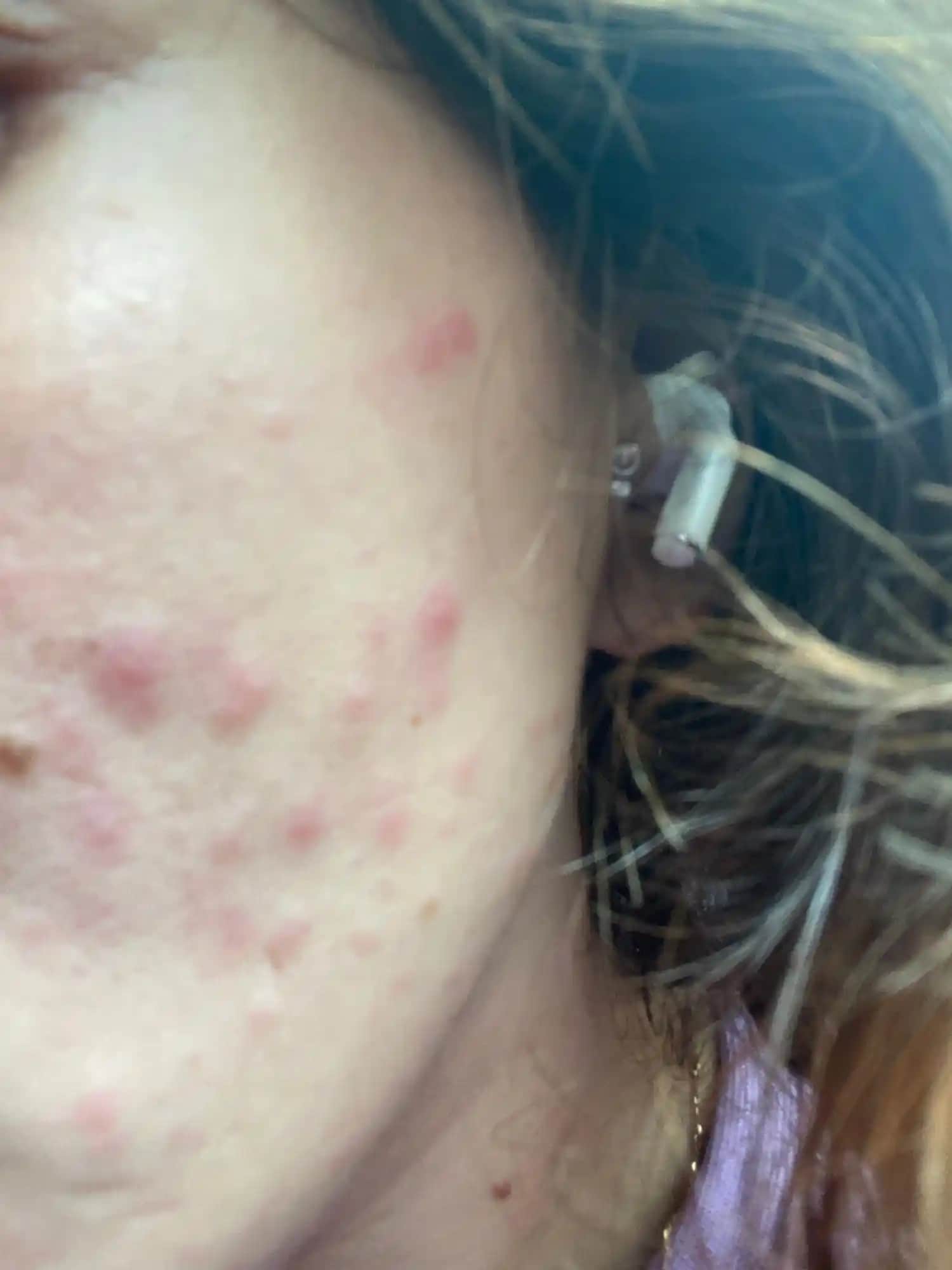 Her Yerde Çıkabilen Sivilce Sorunu ve Çözüm Yolları