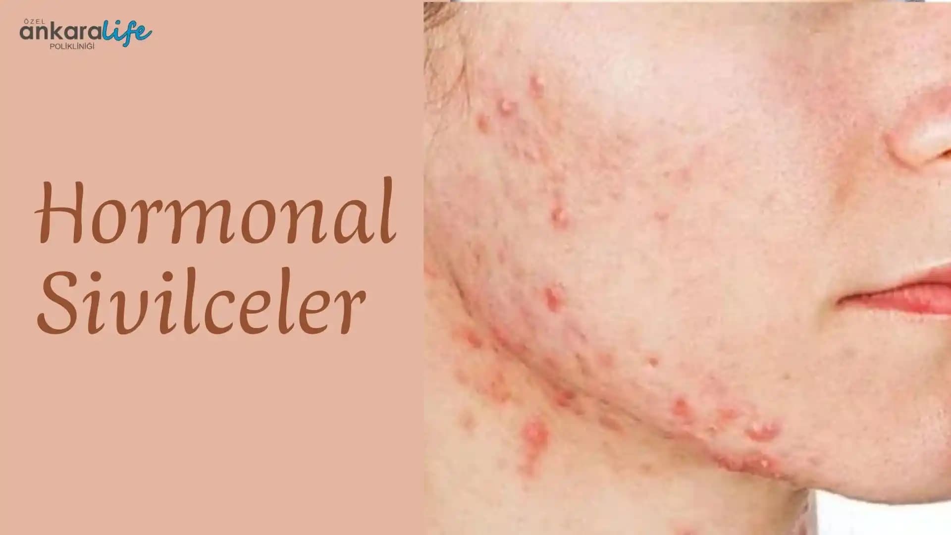 Hormonal Sivilce Nedenleri ve Çözüm Yolları: Etkili Tedavi ve Bakım Tavsiyeleri