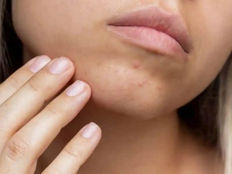 Hormonal Sivilcelerin Belirtileri ve Tedavi Yöntemleri Hakkında Kapsamlı Bilgi