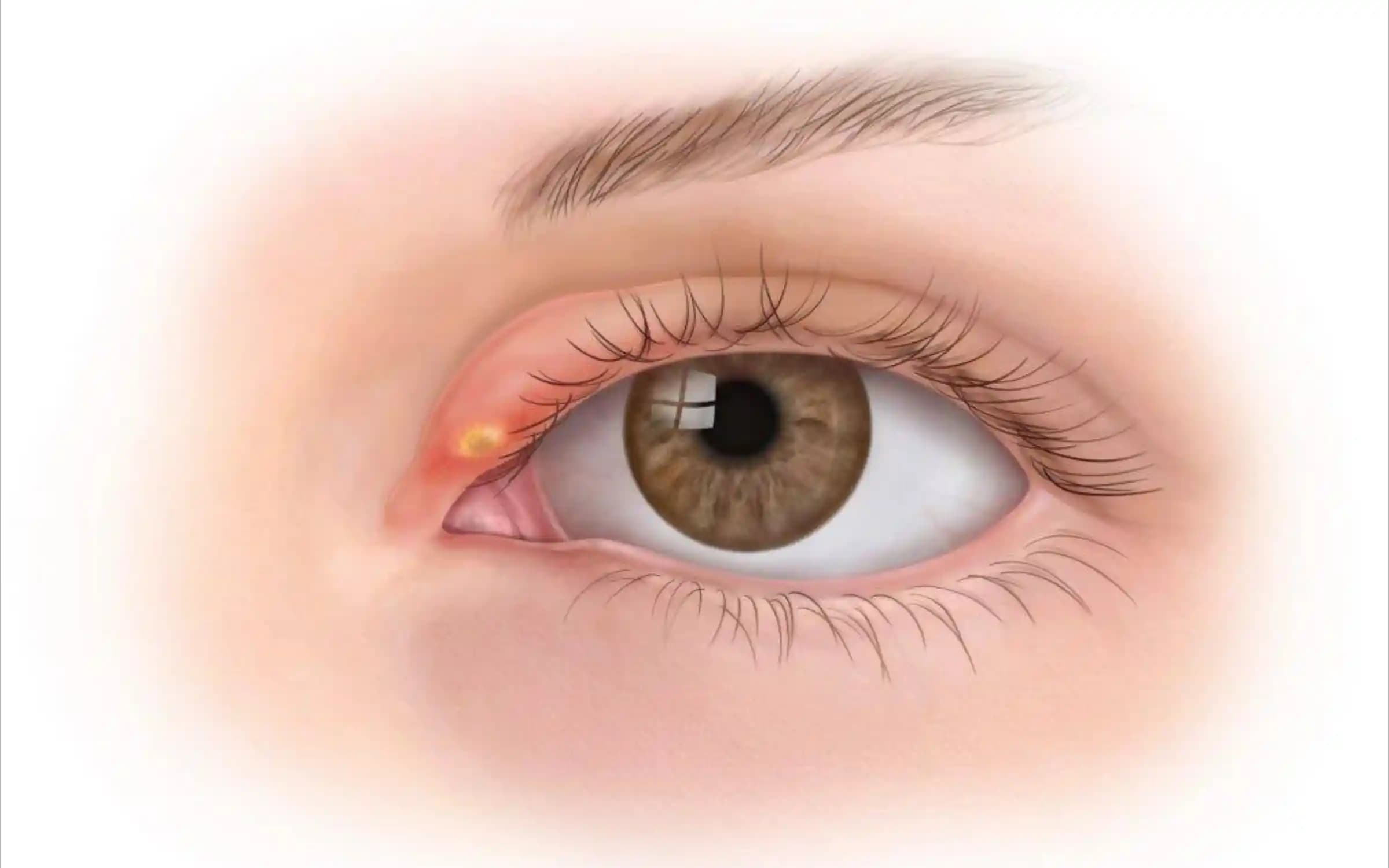 İçi Boş Sivilceler ve Cilt Sağlığını Koruma Yöntemleri Hakkında Kapsamlı Rehber