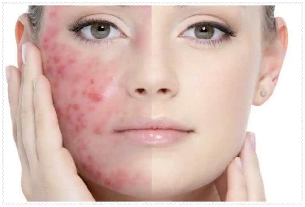 İltihaplı Sivilceler: Nedenleri, Tedavi Yöntemleri ve Cilt Sağlığını Koruma İpuçları