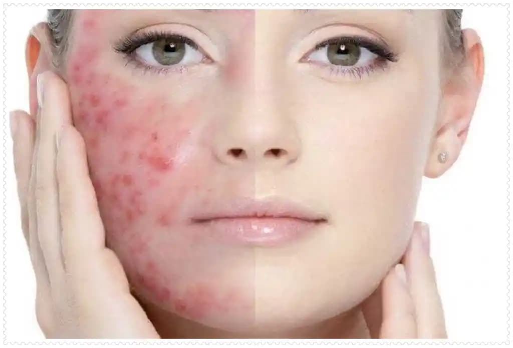 İltihaplı Sivilceler: Nedenleri, Tedavi Yöntemleri ve Cilt Sağlığını Koruma İpuçları