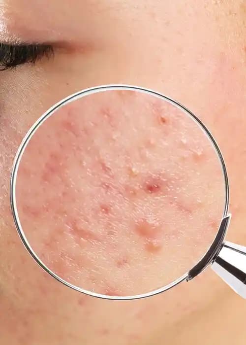 İltihapsız Sivilce Nasıl Tedavi Edilir ve Sağlıklı Cilt İçin İpuçları