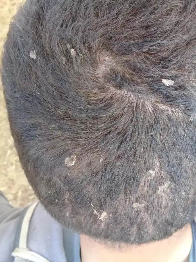 Kafa Derisinde Deri Soyulmasının Nedenleri ve Etkili Çözüm Yöntemleri