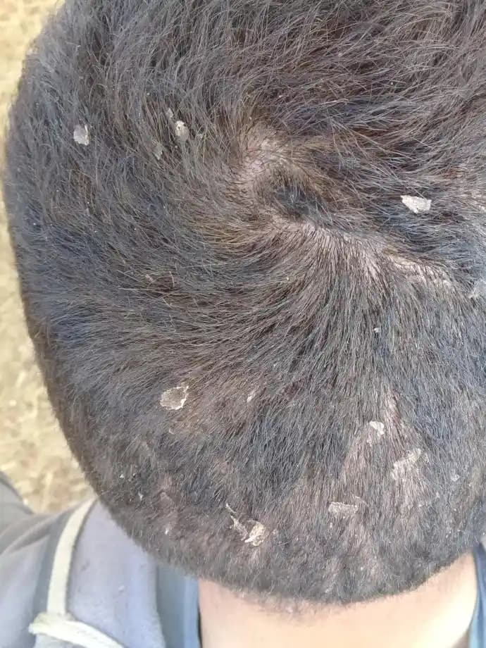 Kafa Derisinde Deri Soyulmasının Nedenleri ve Etkili Çözüm Yöntemleri