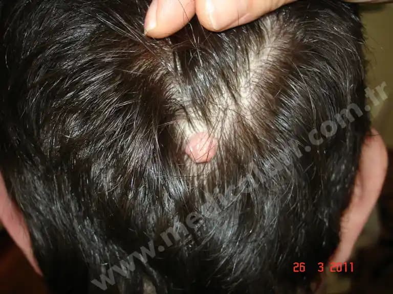 Kafa Derisinde Siyah Lekelerin Nedenleri ve Etkili Tedavi Yöntemleri