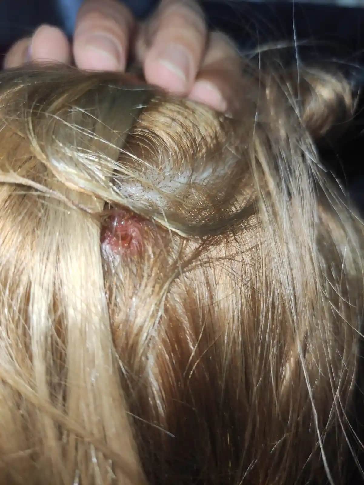 Kafa İçinde Yara Çıkmasının Nedenleri Belirtileri ve Korunma Yöntemleri