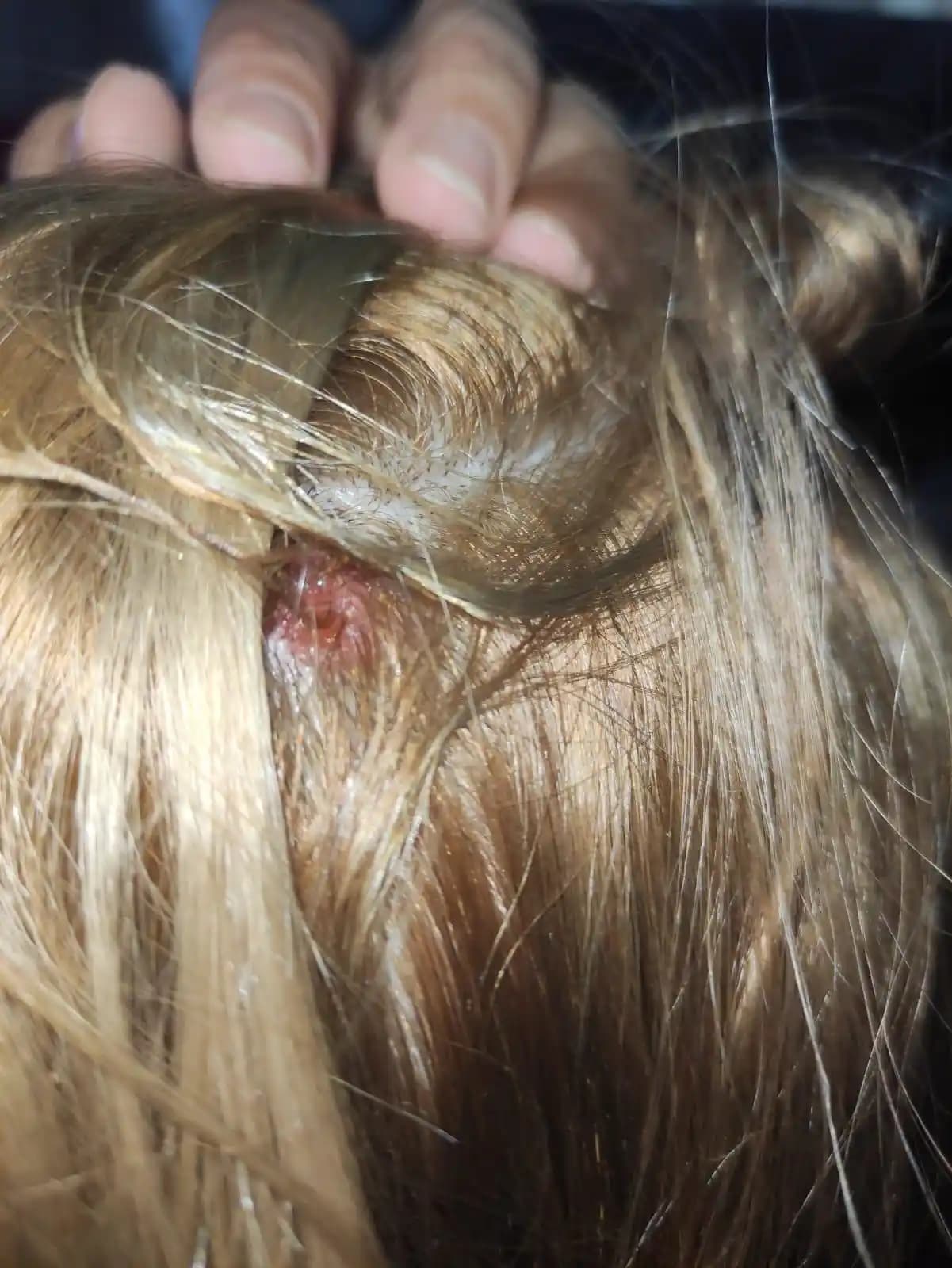 Kafa İçinde Yara Çıkmasının Nedenleri Belirtileri ve Korunma Yöntemleri