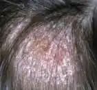 Kafa Mantarı Nedenleri Belirtileri ve Doğal Tedavi Yöntemleri Hakkında Bilgi