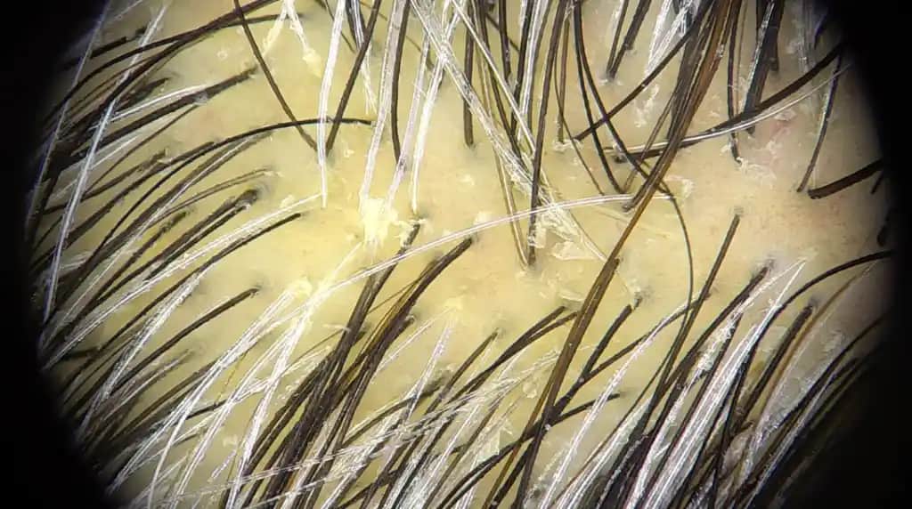 Kafada Sarı Kabuk Nedenleri, Belirtileri ve Etkili Bakım Yöntemleri