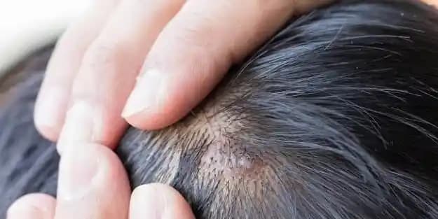 Kafadaki Sivilcelerin Nedenleri ve Etkili Tedavi Yöntemleri