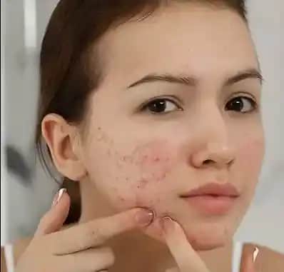 Kafein ve Sivilce İlişkisi: Cilt Sağlığını Etkileyen Faktörler ve Bilinçli Tüketim Önerileri