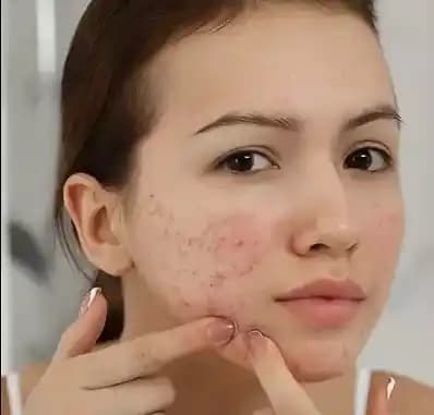 Kafein ve Sivilce İlişkisi: Cilt Sağlığını Etkileyen Faktörler ve Bilinçli Tüketim Önerileri