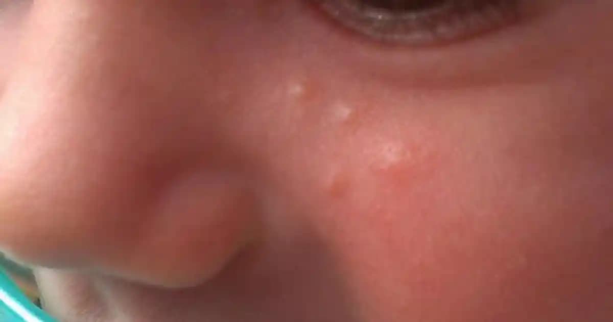 Kapalı Sivilce Nedir, Belirtileri ve Etkili Tedavi Yöntemleri Hakkında Kapsamlı Bilgi