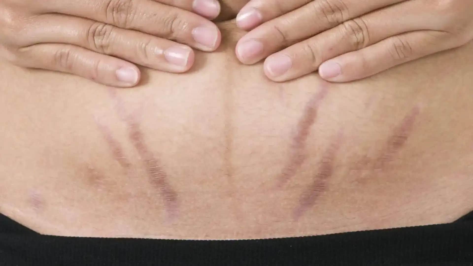 Karın Bölgesinde Kızarıklık Nedenleri ve Çözüm Yolları Üzerine Detaylı Bilgi