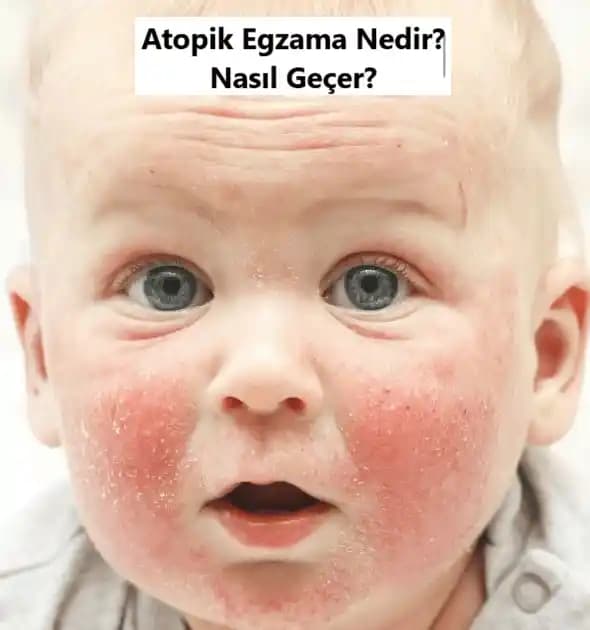Karında Egzama Nedenleri, Belirtileri ve Uygun Kozmetik Yaklaşımlar Rehberi