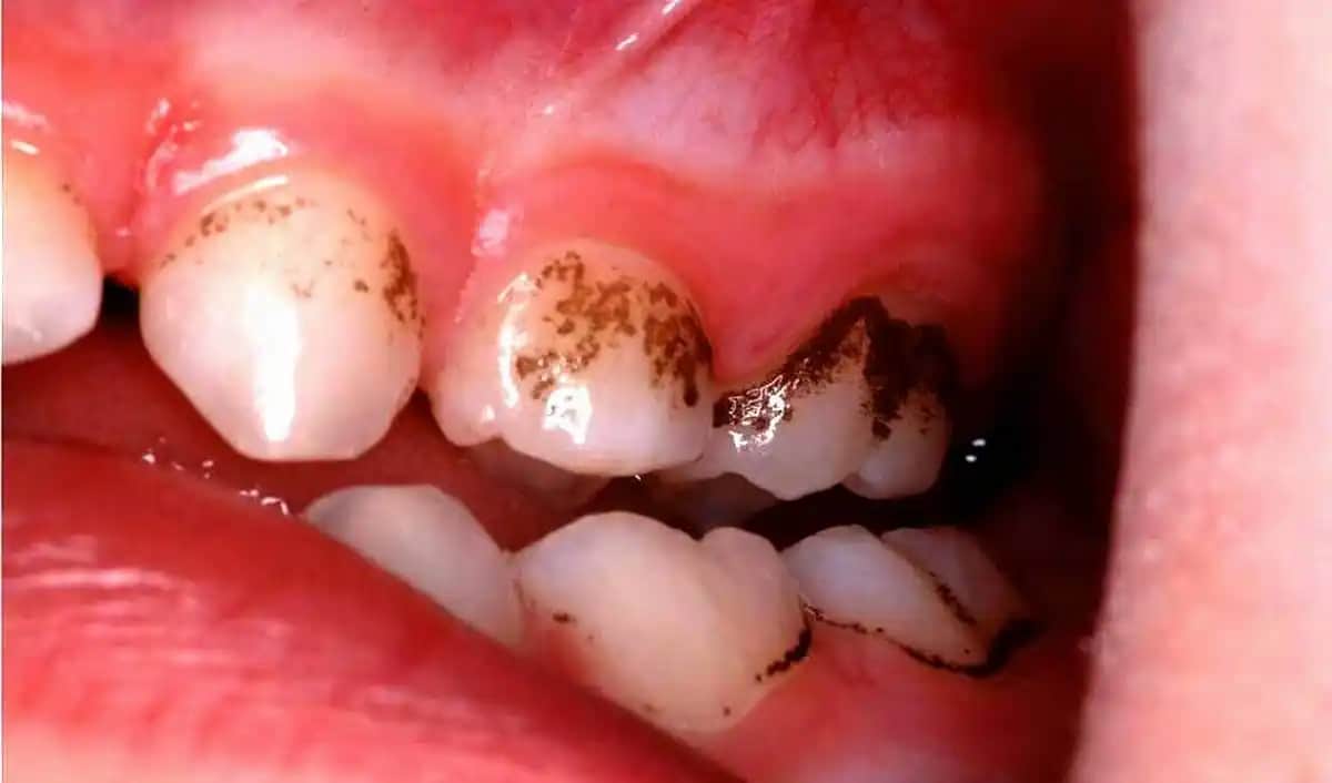 Kasık Bölgesinde Siyah Lekeler ve Renk Değişiklikleri Hakkında Bilmeniz Gerekenler