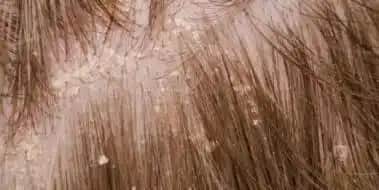 Kepek Hastalığı ve Çözüm Yolları: Saç Sağlığını Koruma Rehberi