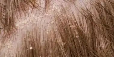 Kepek Hastalığı ve Çözüm Yolları: Saç Sağlığını Koruma Rehberi