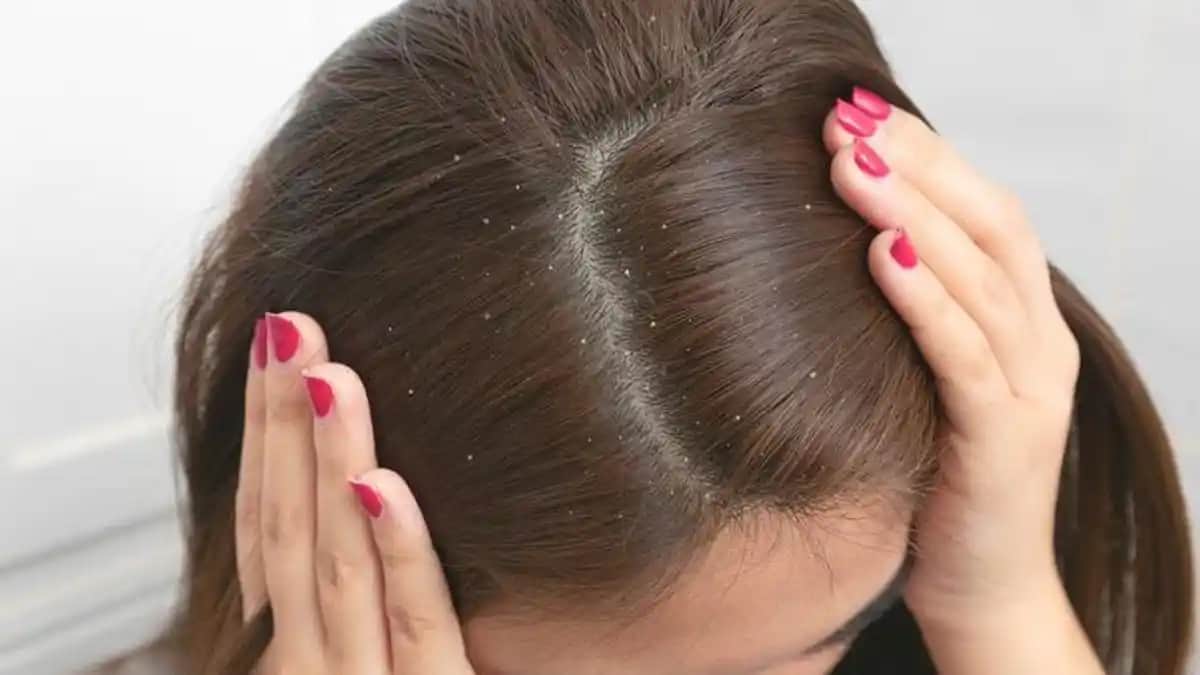 Kepek Problemi ve Çözüm Yolları: Saç Sağlığını Koruma Yöntemleri ve Tavsiyeler