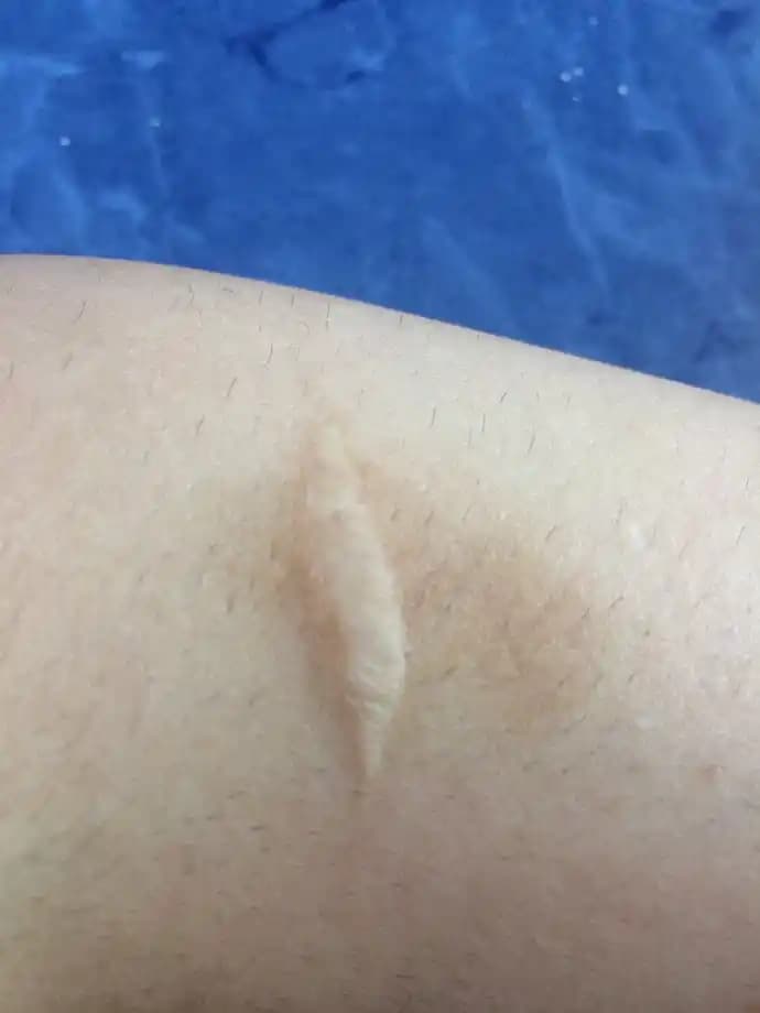 Kesik İzleri Nasıl Giderilir? Etkili Çözüm Yolları ve Günlük Bakım Önerileri