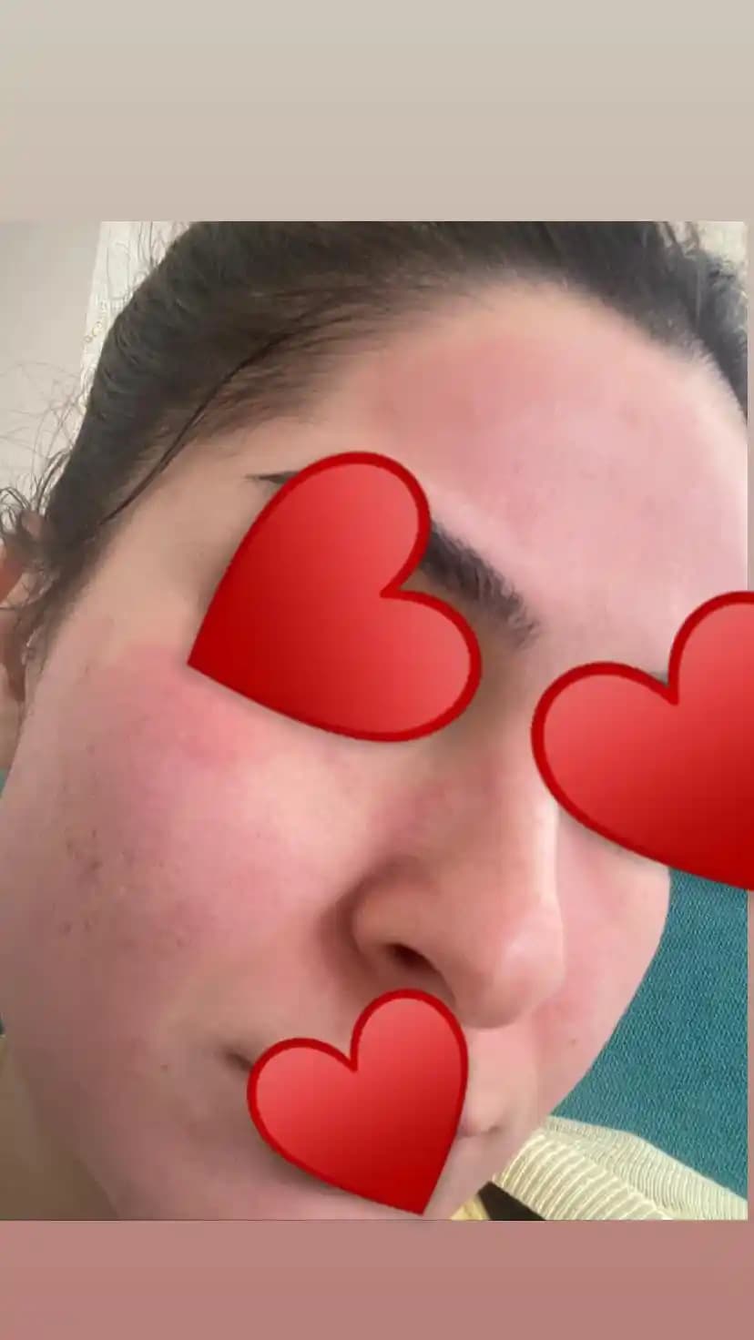 Kil Maskesi Sonrası Kızarıklık Nedenleri ve Etkili Çözüm Yolları