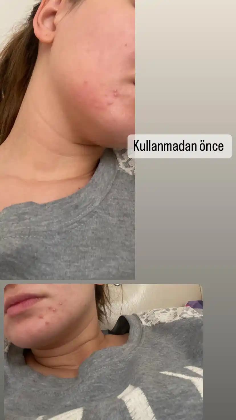 Kırmızı Asidin Kozmetikteki Rolü ve Güvenliği Hakkında Detaylı Bilgi