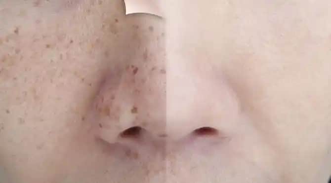 Kırmızı Çil Nedir, Belirtileri ve Kozmetik Çözüm Yöntemleri Hakkında Bilgiler