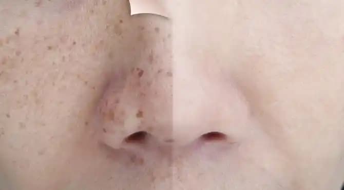 Kırmızı Çil Nedir, Belirtileri ve Kozmetik Çözüm Yöntemleri Hakkında Bilgiler