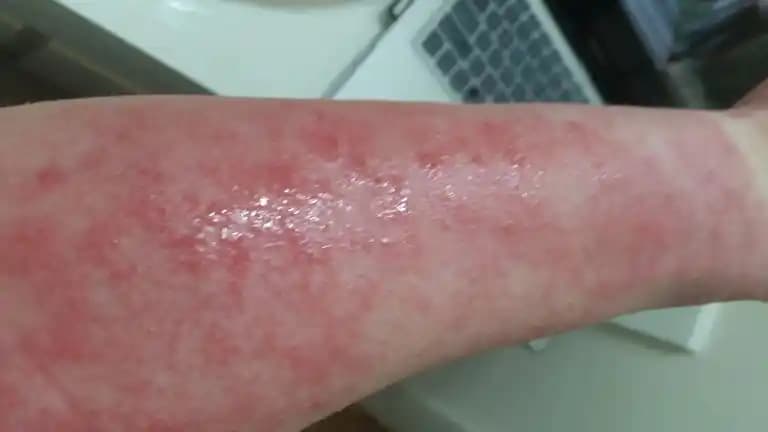 Kırmızı Cilt Lekeleri: Nedenleri, Tedavi Yöntemleri ve Günlük Bakım İpuçları