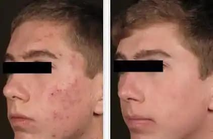 Kırmızı Sivilce İzlerini Azaltma Yolları ve Etkili Tedavi Seçenekleri