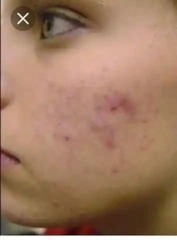 Kırmızı Sivilce Lekeleri: Nedenleri, Tedavi Yöntemleri ve Cilt Bakım İpuçları