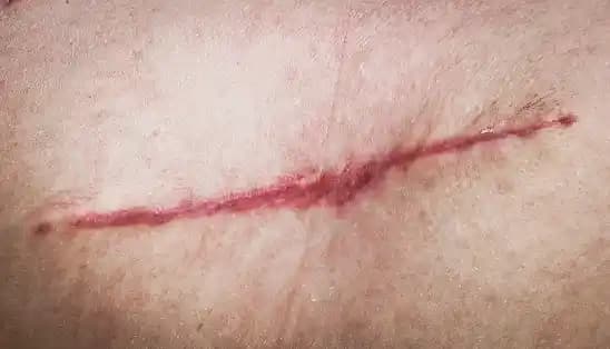 Kırmızı Yara İzleri İçin Güncel Kozmetik Çözümler ve Yenilikler Hakkında Bilgi