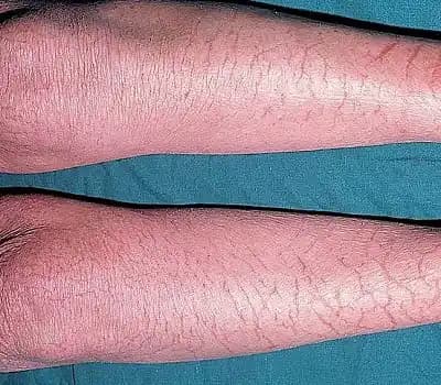 Kış Egzaması Nedir? Belirtileri, Nedenleri ve Etkili Çözüm Yöntemleri