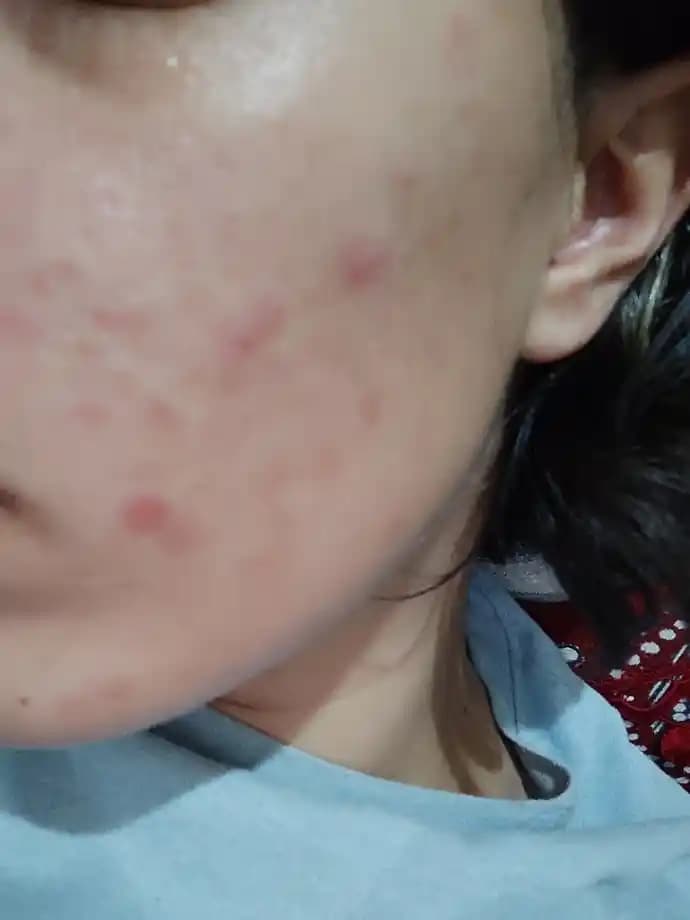 Kızarık Yüze Doğal ve Kozmetik Çözümler ile Kalıcı Rahatlama Yöntemleri