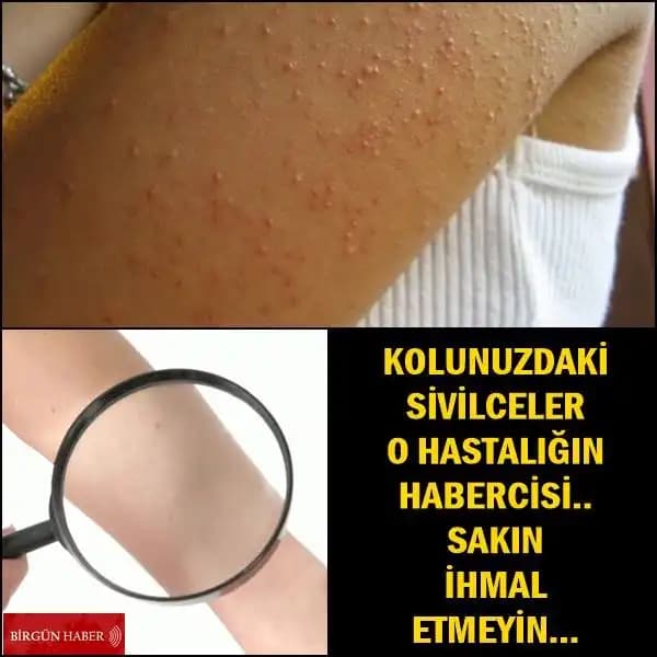 Kol Arkası Sivilcesi Nedenleri ve Doğru Bakım Yöntemleri Rehberi